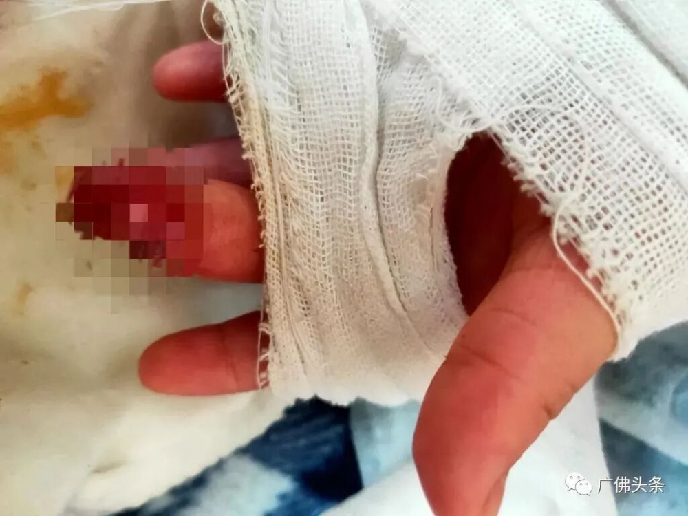 近日內地一名女童手指長時間被橡筋纏著，導致手指腫脹、呈紫黑色，送院後證實瀕臨缺血性壞死險要截指。