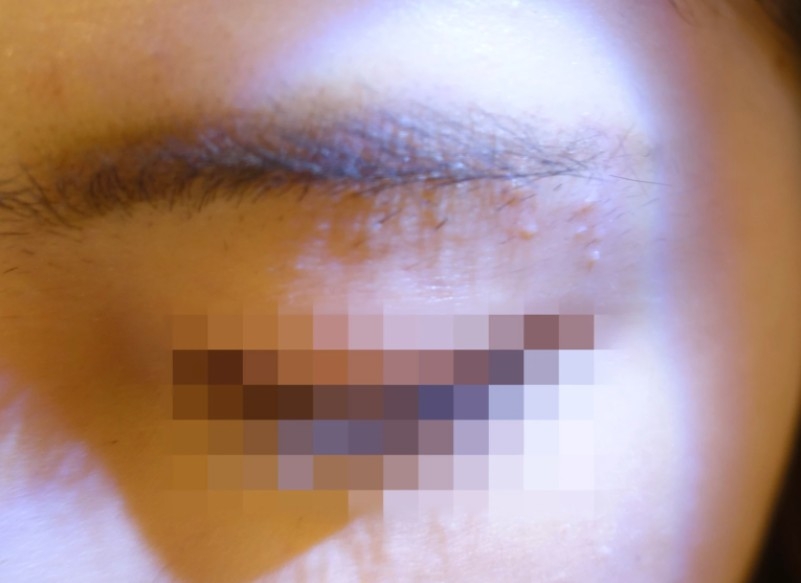 台灣一名20多歲的女子紋眉後感染病毒疣,眉間長出50粒小肉芽。