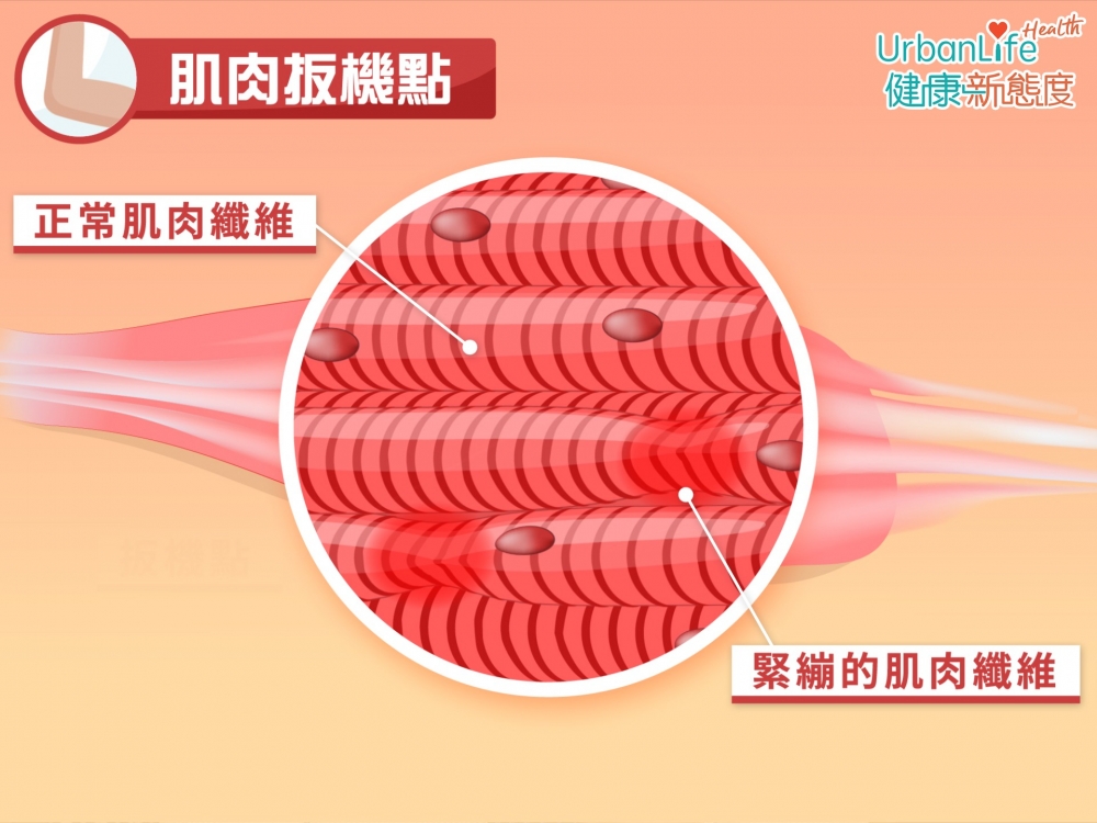 ,針刺扳機點可以引起局部跳動反應,使那些縮短了的肌肉纖維部分緩解。