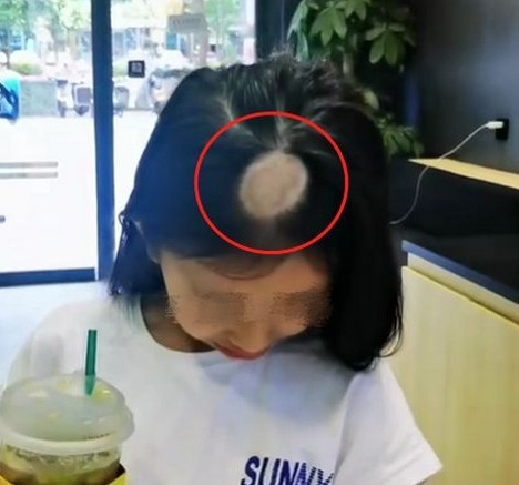 中國一名女童在本月頭開始飼養一隻小貓,不料因此感染貓癬,不斷掉髮,結果要剃光頭頂塗藥。