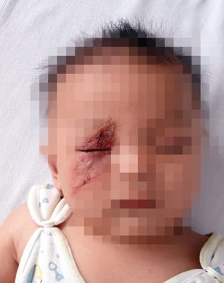 浙江杭州一名媽媽,拍走停留在女兒臉上的蟲子,隨後女兒臉上竟出現5厘米長紅印且皮膚潰爛。