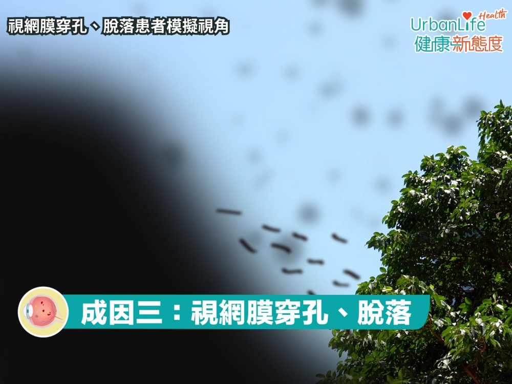 視網膜穿孔、脫落患者，亦有機會出現飛蚊，需立即處理。