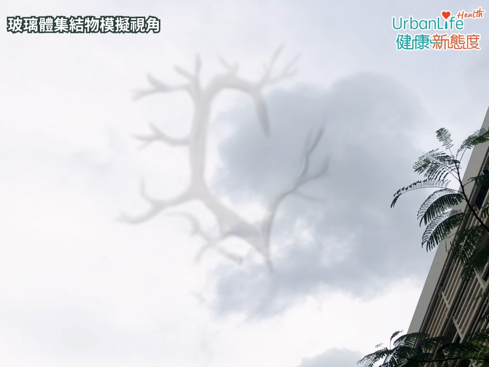 玻璃體集結物：眼睛內原本有一些呈透明、啫喱狀的玻璃體，惟有時或會出現一些雜質，繼而令人見到飛蚊。