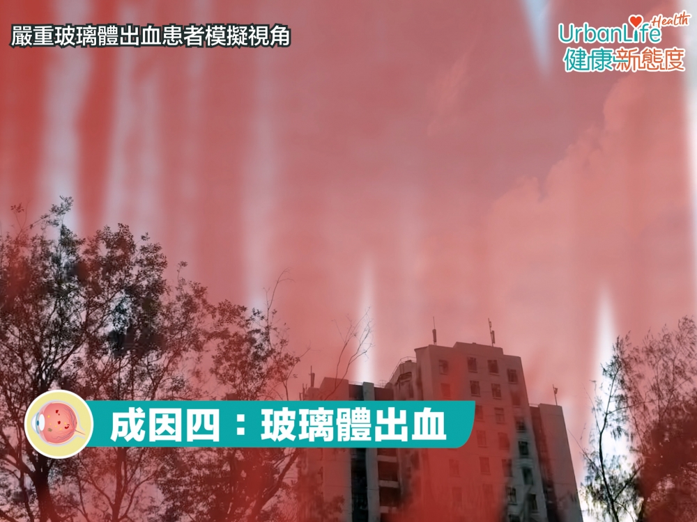 例如有些人糖尿病上眼，如玻璃體出血，亦會見到飛蚊。