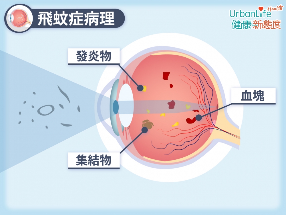 在某些情況下，如年紀、撞擊等原因，以致玻璃體中間變得不再透明，出現集結物、發炎細胞、出血等情況，就會有影子投影至視網膜，令人在視野中見到「飛蚊」。
