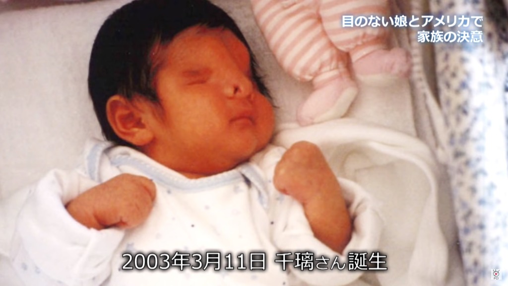 一名日本媽媽於18年前迎來首個孩子,可惜女兒一出生便患有罕見病「無眼球症」,同時亦因頭骨生長異常而呼吸困難兼有語言障礙,媽媽更一度想過與女兒輕生。