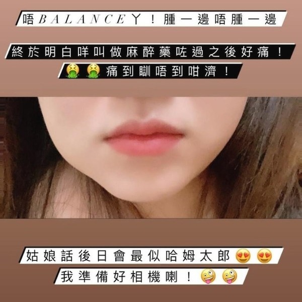 藝人江嘉敏上周到牙醫診所剝走3隻智慧齒,其後一邊臉部腫脹,需要服用止痛藥。