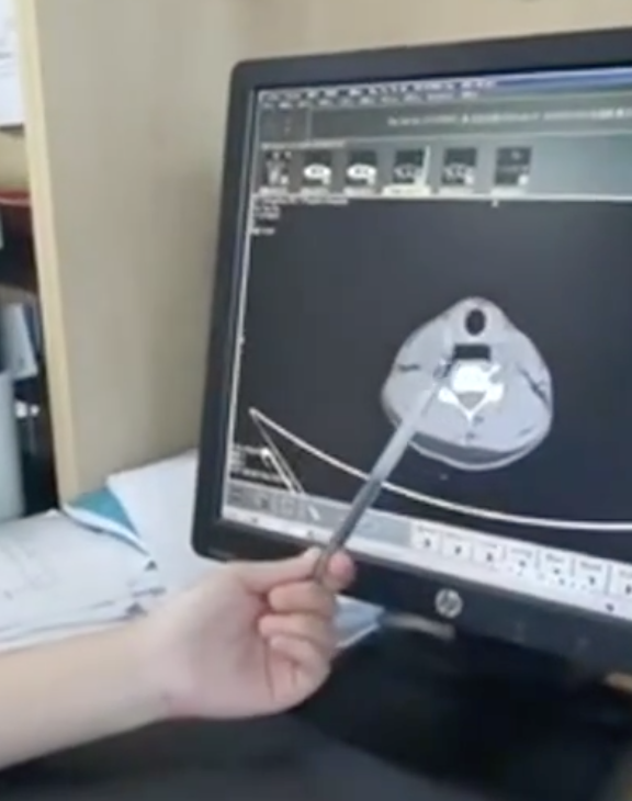 中國江蘇一名青少年用牙齒開可樂瓶蓋,結果在打開的一瞬間,強烈氣流將瓶蓋衝入食道。