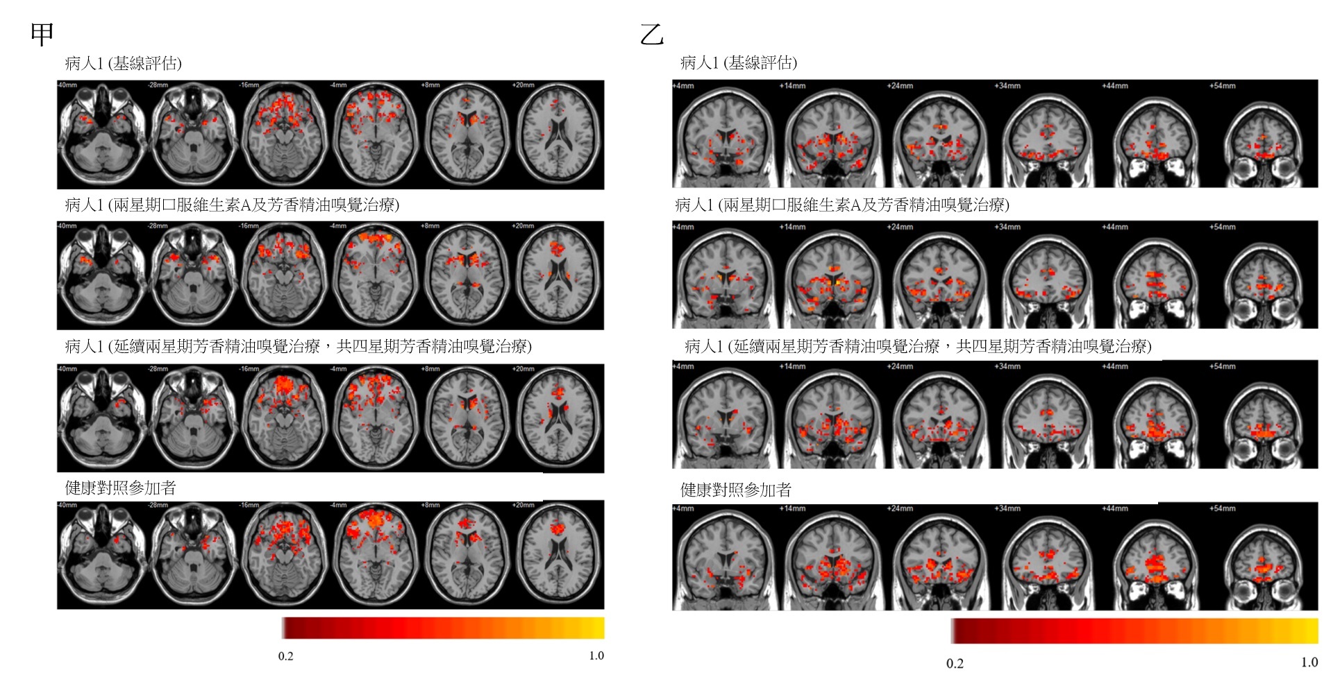 大腦功能性磁力共振掃描(rs-fMRI)顯示患者接受治療後(乙)的嗅覺神經網絡連接信號得到改善。