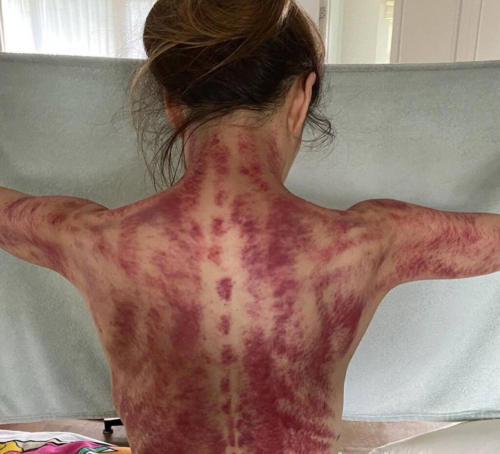 鄭秀文刮痧後背脊充滿血痕。