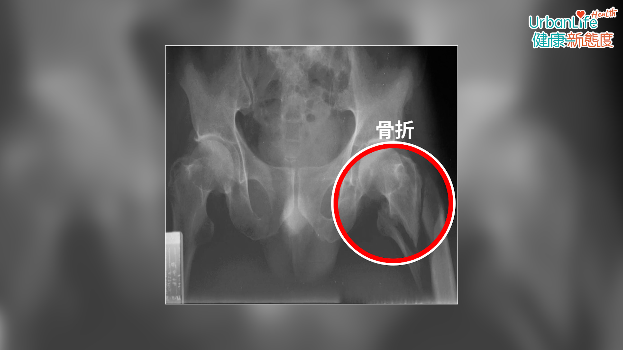 長者跌倒骨折有四分一皆是髖骨關節骨折。