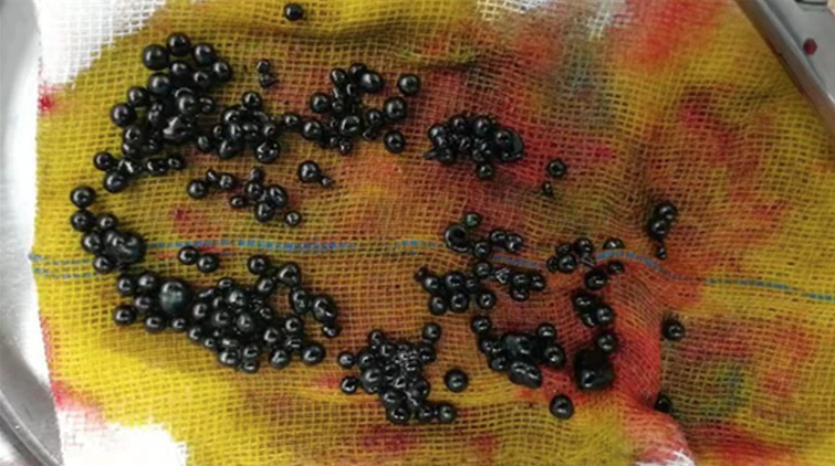 杭州一名15歲男孩平日十分愛吃炸雞，但最近突然一吃炸雞就肚痛，求醫查出膽囊漲如芒果，更內藏了上百顆膽結石。