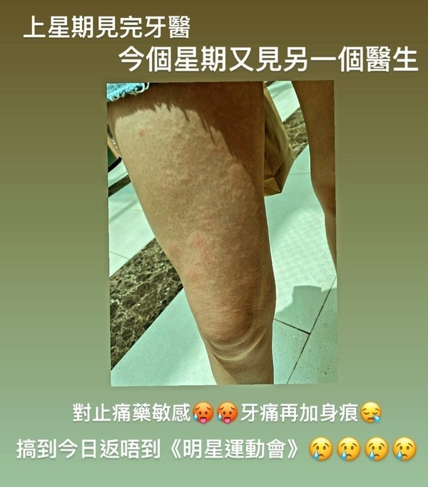藝人江嘉敏近日剝智慧齒後服食止痛藥,其後大腿生風癩,求醫證實藥物敏感。