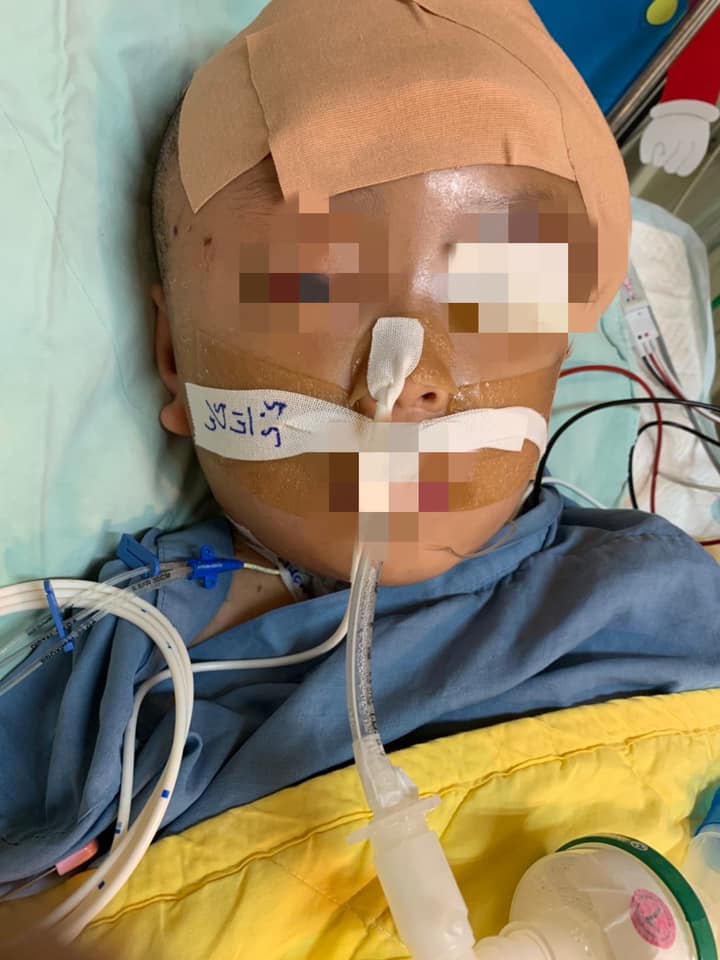 男童手術後一直在深切治療部留醫房,醫院本月初指出,黃童目前昏迷指數3分,整體腦部、呼吸及消化功能尚不佳,呼吸狀況仍需依賴呼吸器