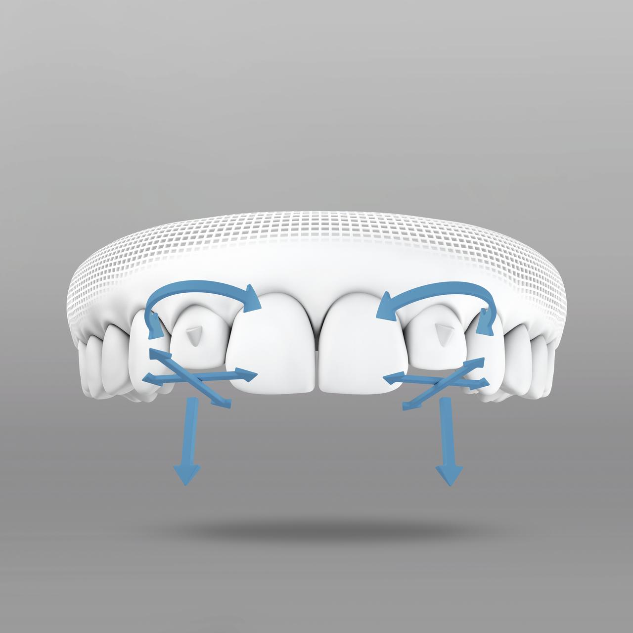 SmartForce技術能為牙齒帶來精準力點移動