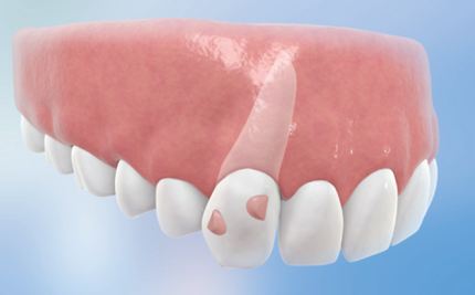 SmartForce技術能為牙齒帶來精準力點移動