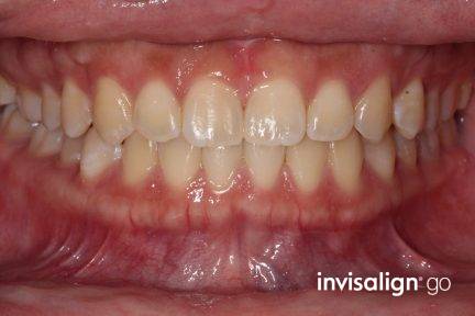 隱適美.易真實個案分享2