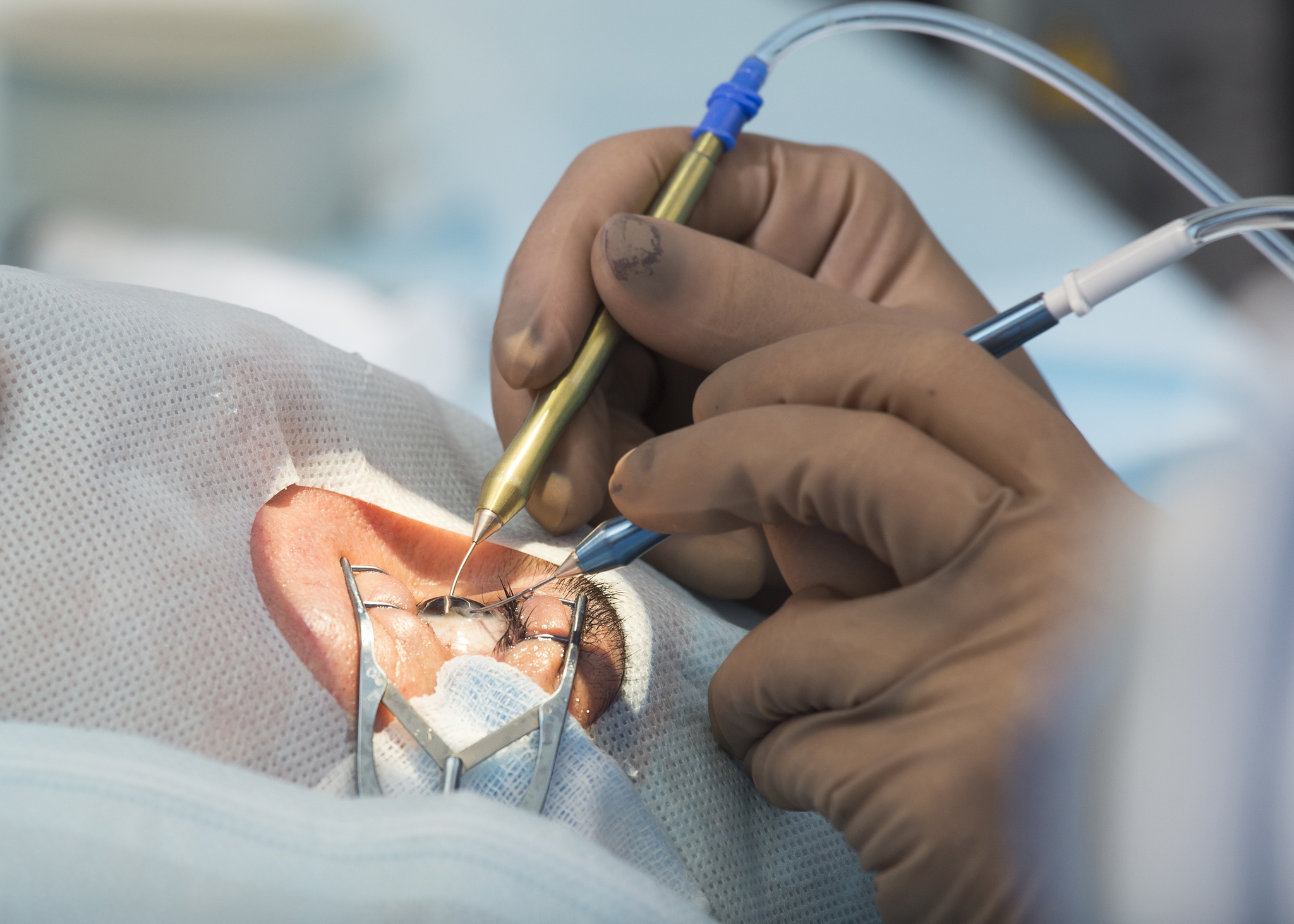 內地一名40多歲的女士近日視力模糊，求醫發現已患白內障。