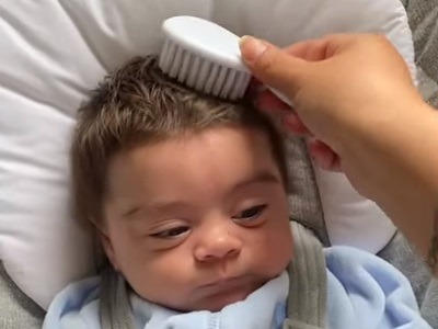 為了保持Jaxon-James的血糖處於正常狀態,他需要定時服用藥物Diazoxide,但藥物的副作用就是令毛髮異常生長。