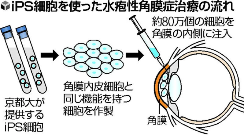 日本慶應大學獲政府批准進行一項臨床研究,以誘導性多能幹細胞(iPS細胞)所製的細胞移植到罹患水疱性角膜症患者的角膜。