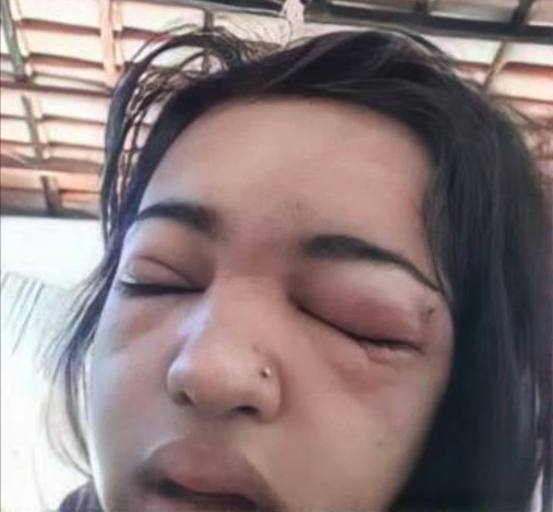 15 歲巴西女孩在家自行穿環,引發傷口感染,臉部嚴重腫脹發炎,眼睛更腫得睜不開。送院後,她經歷4次心臟驟停,一周後不治離世。