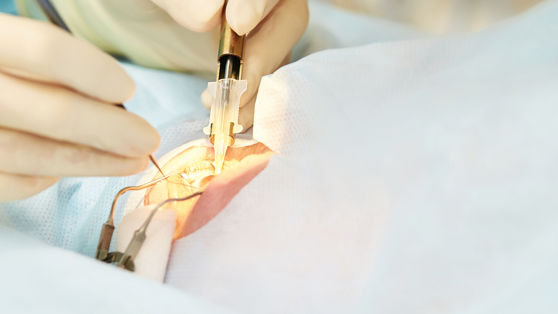 雖然白內障手術有可能失敗,但因應現代醫療技術的發展,此手術已經是十分安全和成熟的治療方法。