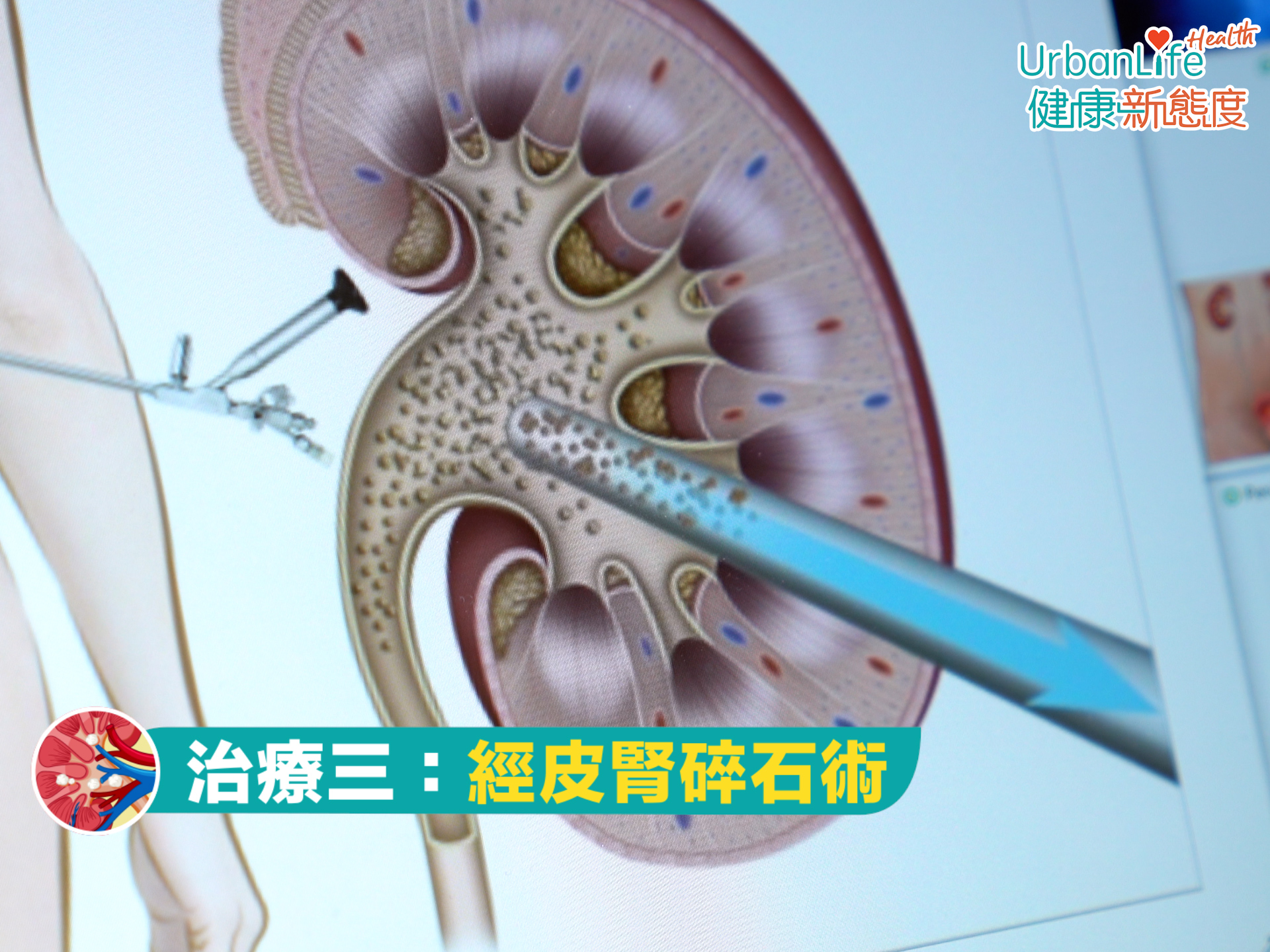 此手術需要在背部開一個半吋長的傷口,可以處理腎臟內、較難處理的結石。