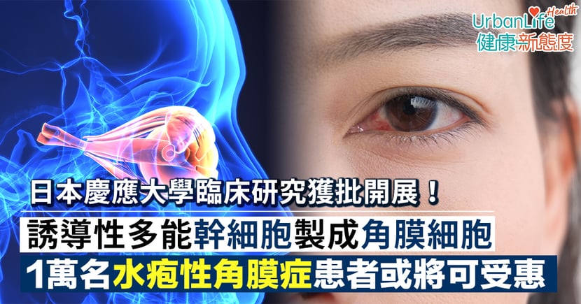 角膜移植 日本批准 角膜細胞移植 水疱性角膜症患者臨床研究 Urbanlife 健康新態度