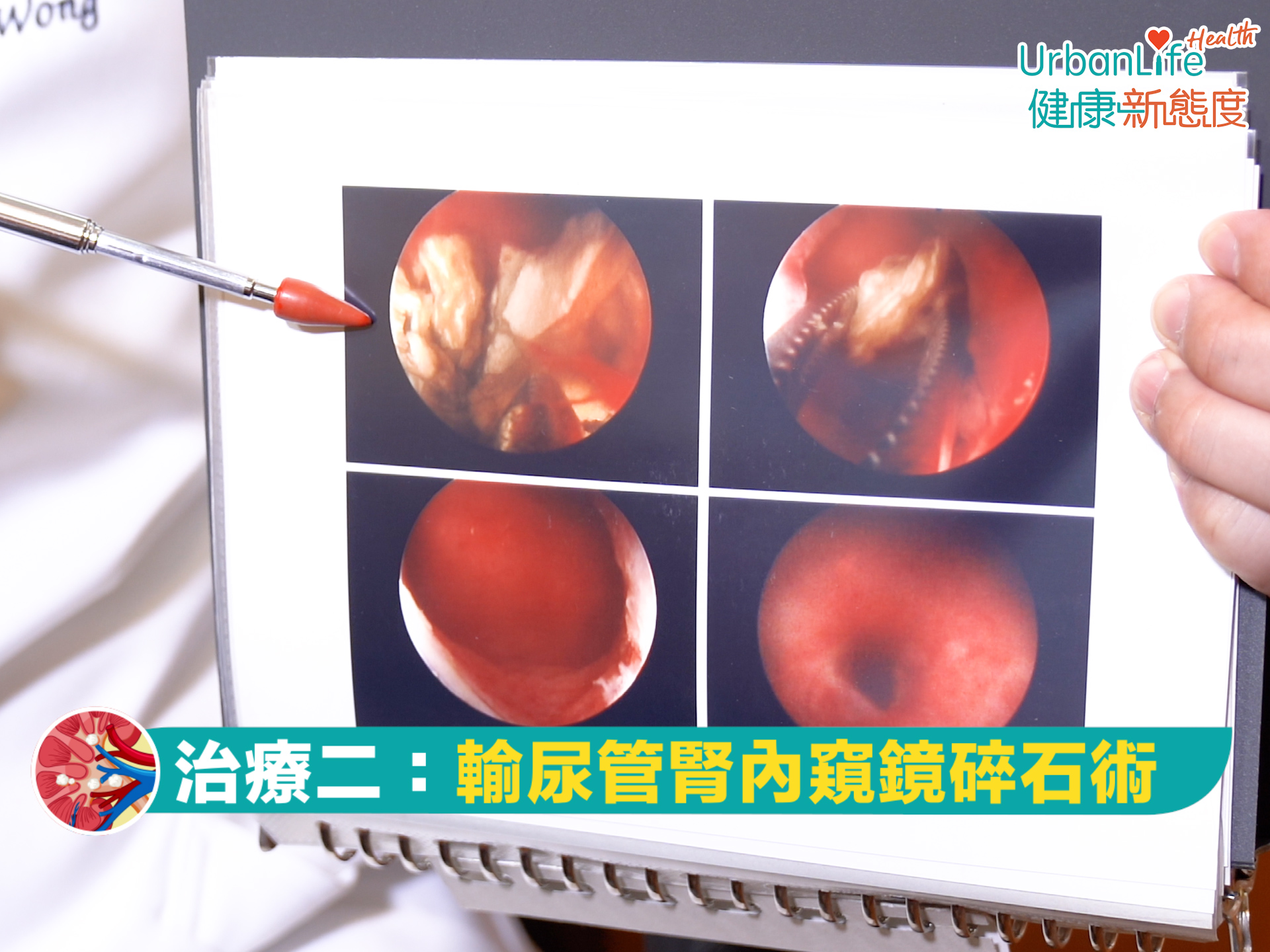 如果體外碎石不成功 另一個可考慮的是輸尿管內窺鏡手術。