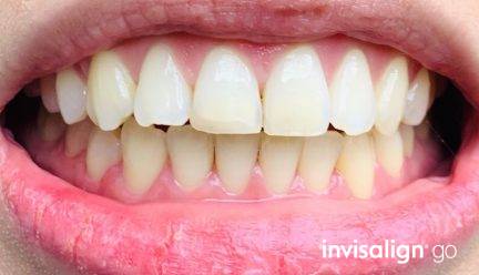 隱適美.易真實個案分享1