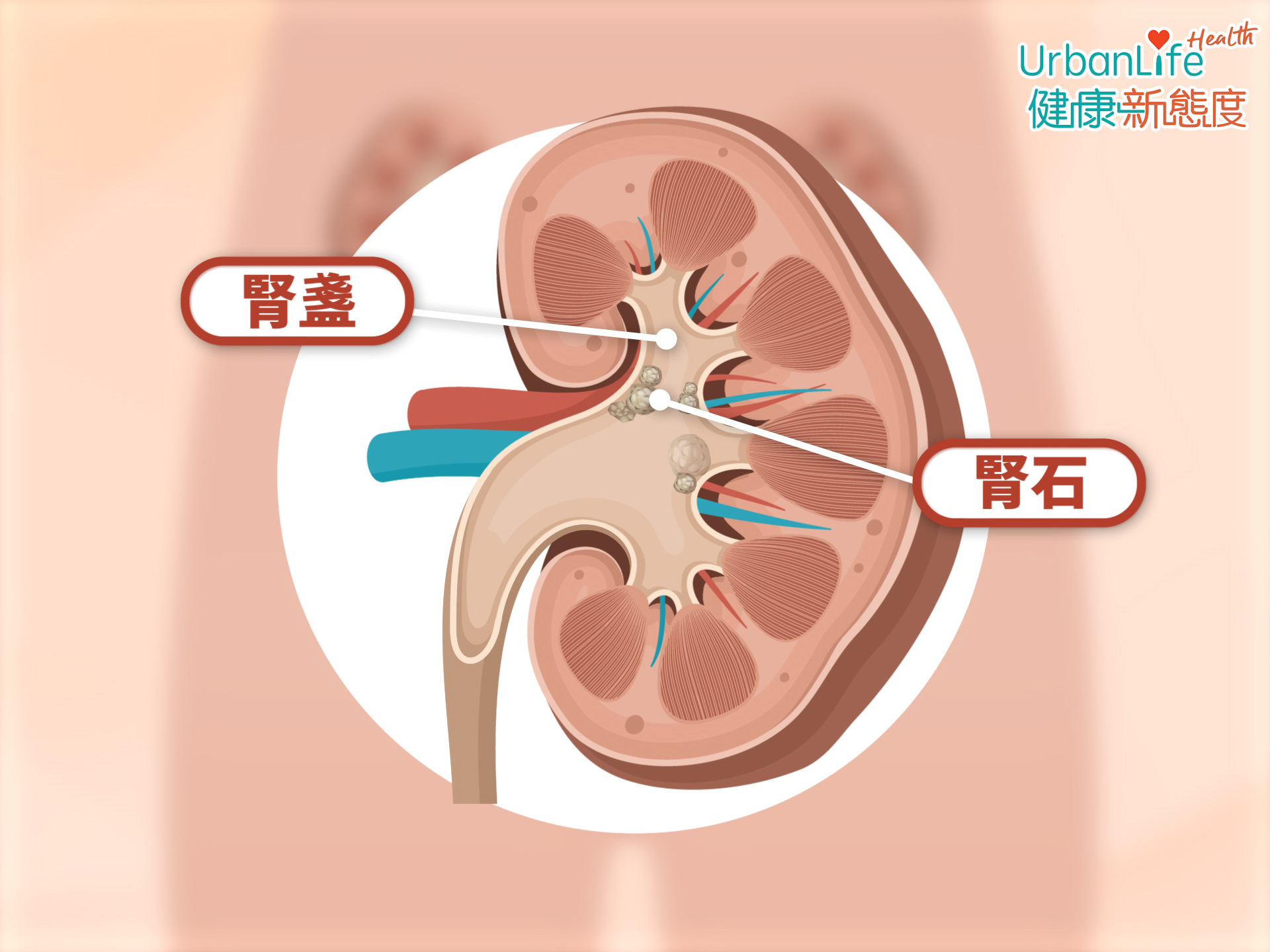 腎結石的形成是由腎臟開始。當腎臟排泄尿液期間,有一些礦物質積聚在腎臟內部一些細小的空間(腎盞),形成小顆的沙粒,有時結集在一起,就會變成腎石。