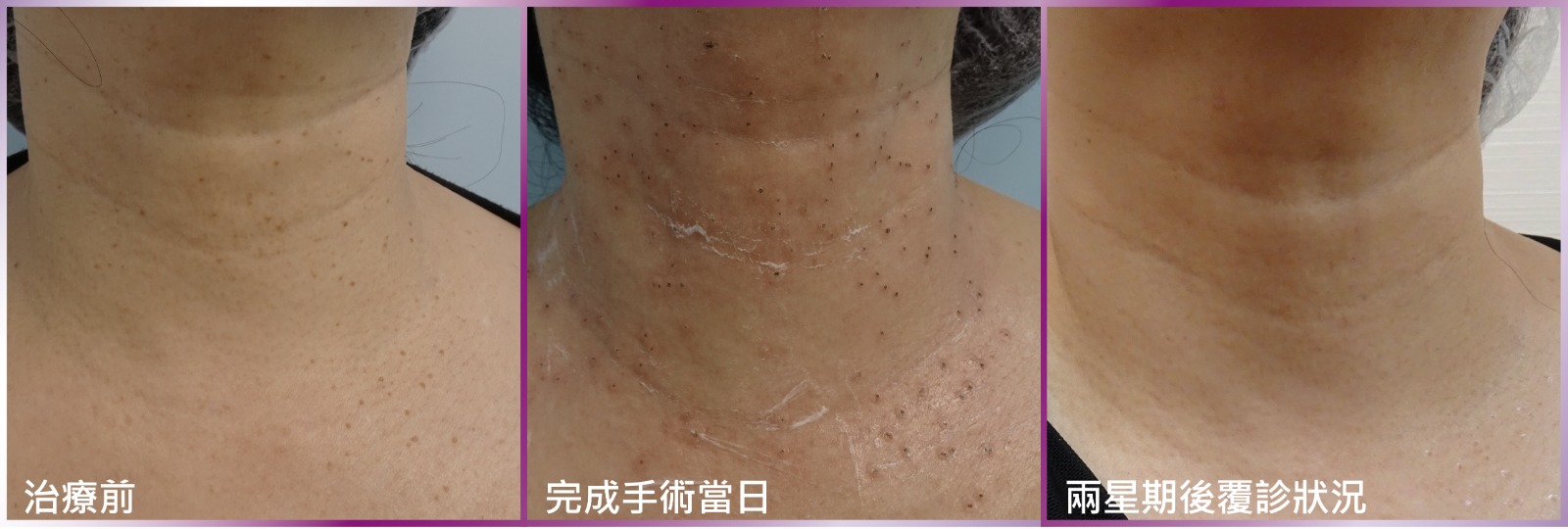 病人接受脫疣手術的前後比較