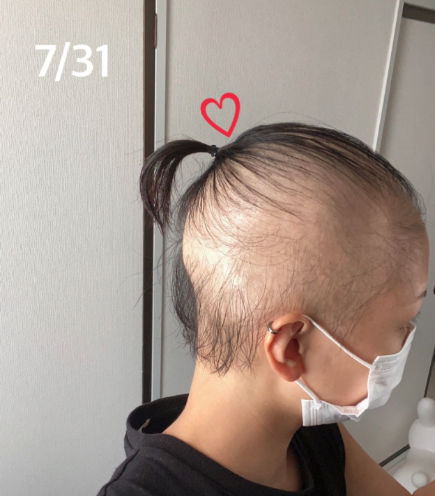 直到7月31日,她已經接近全禿。