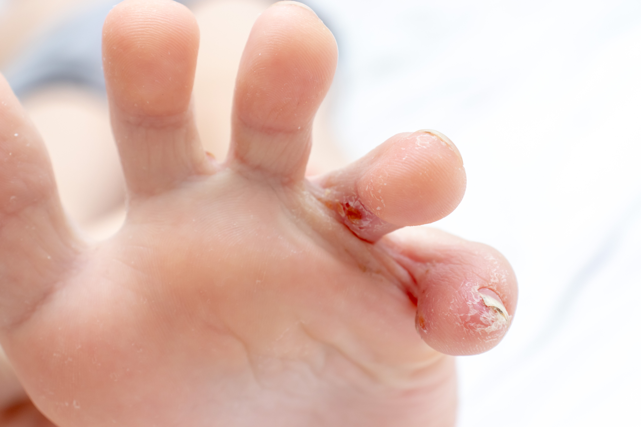 冷熱交替、經常碰水和清潔劑,造成皮脂膜受損,使外部刺激進入皮膚,造成過敏性發炎。