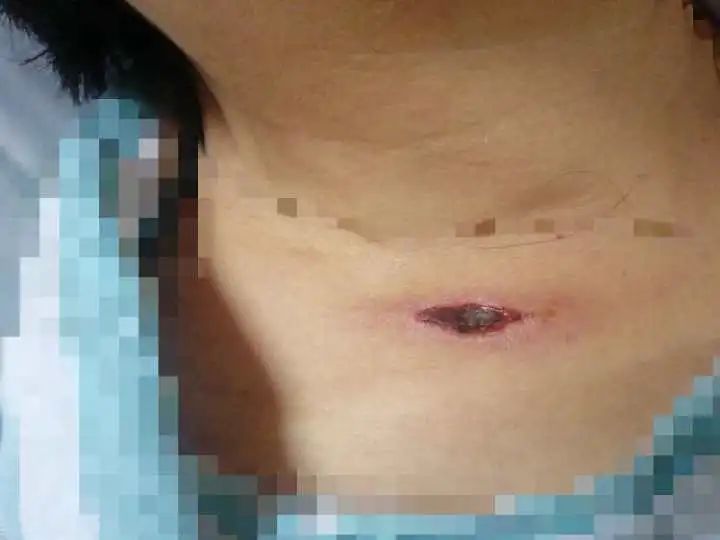 王女士被恙蟲叮咬的皮膚破潰。