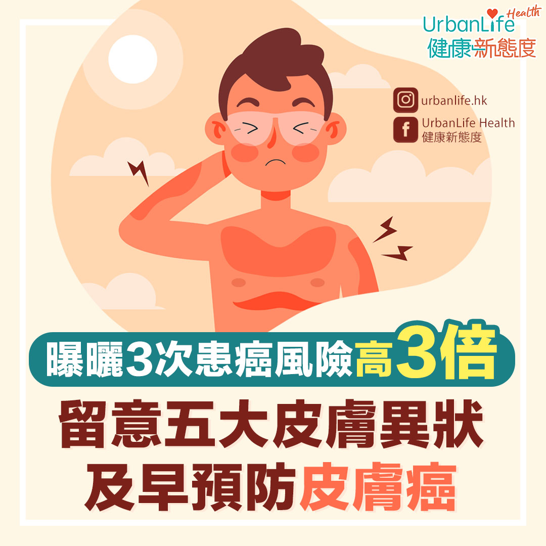 根據香港癌症資料统計中心的資料顯示,2018年錄得的癌症新症中,有3.5%屬皮膚癌,而皮膚癌種類之一的非黑色素瘤皮膚癌,更是本港十大常見癌症中第八位。