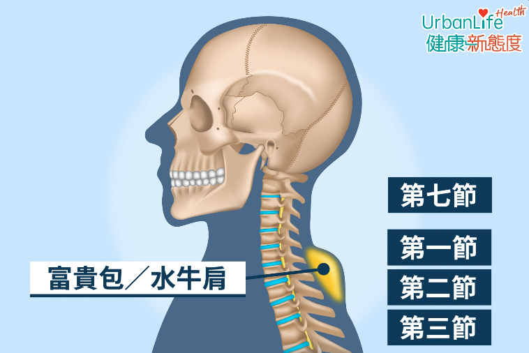 富貴包一般發生在頸椎的第七節,胸椎的一、二、三節附近。因肉眼上看會像腫起一個包般,故俗稱「富貴包」,又叫「水牛肩」。