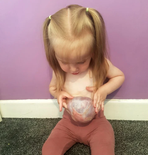 英國一名3歲女童罹患罕見的先天性畸形疾病「臍膨出」。