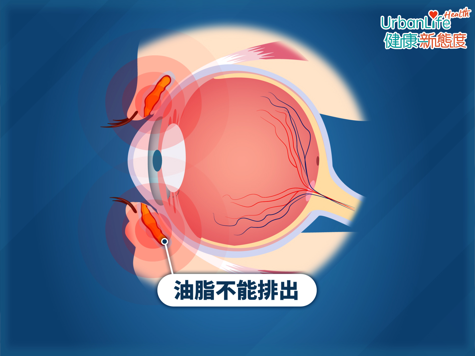 當油脂出來時,油脂孔堵塞,油脂不能正常排出,便會堆積於油脂腺,當愈來愈多油脂積聚,便會形成眼瘡。