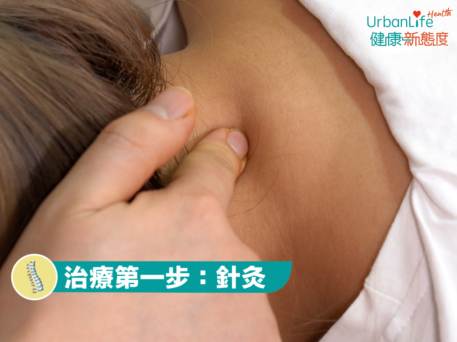 治療頸椎病會先為患者進行針灸,當中常用穴位有四個,如風池穴、夾脊穴(頸夾脊)、頸百勞,及肩井穴。