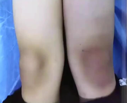 父母發現鵬鵬兒子雙腿粗幼不一，顏色亦有不同。