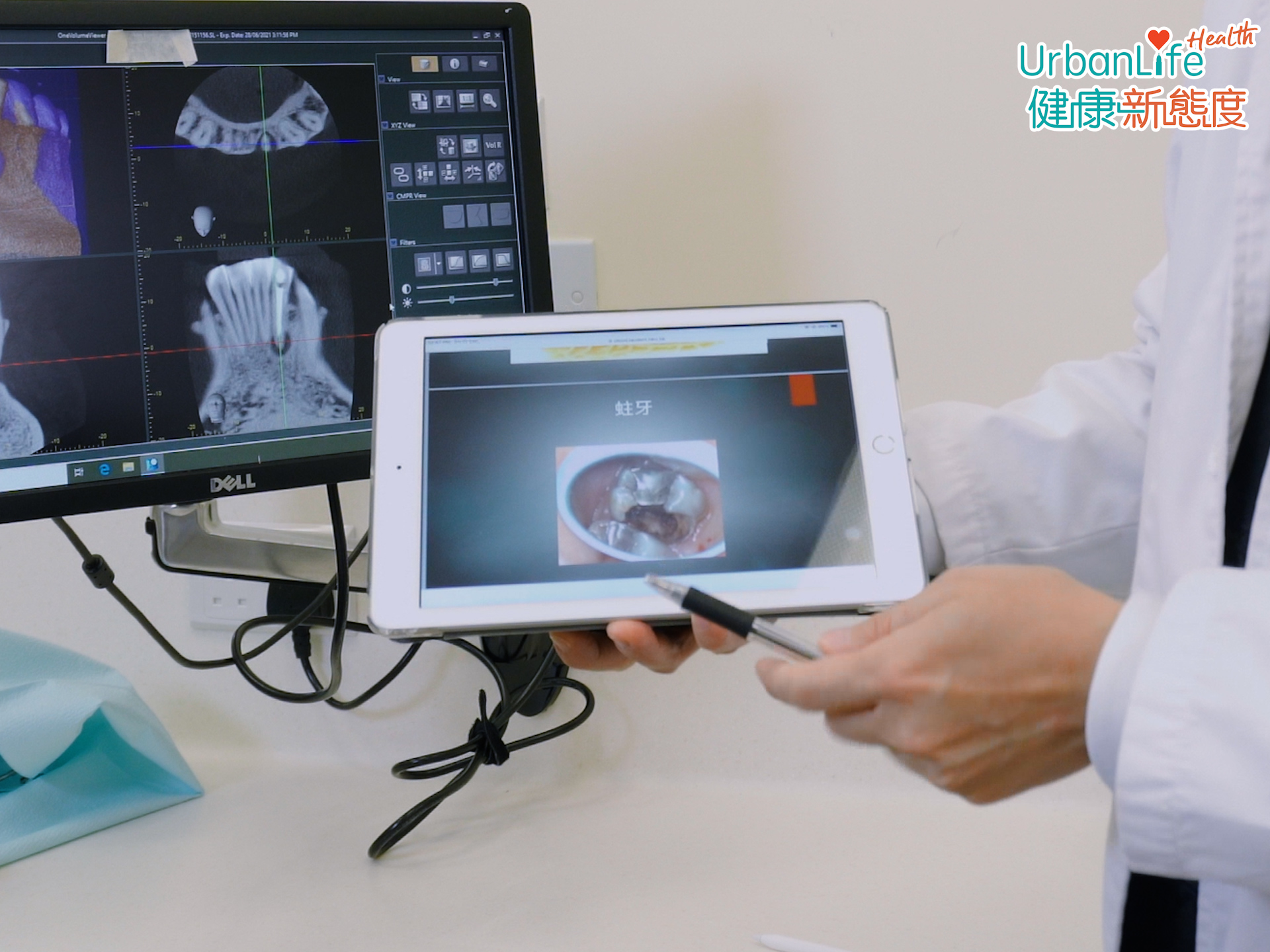 嚴重蛀牙、牙周病都可致牙髓炎,繼而需要牙髓治療。