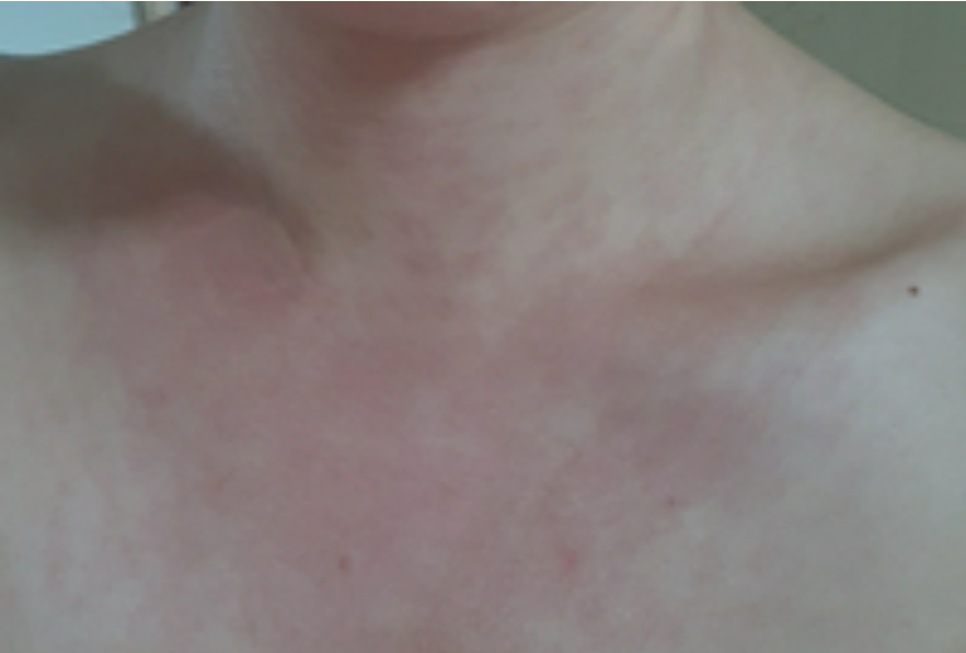 名為nicole3768的女網民打完疫苗後從頸部、胸腔一直到四肢皆出了紅疹。