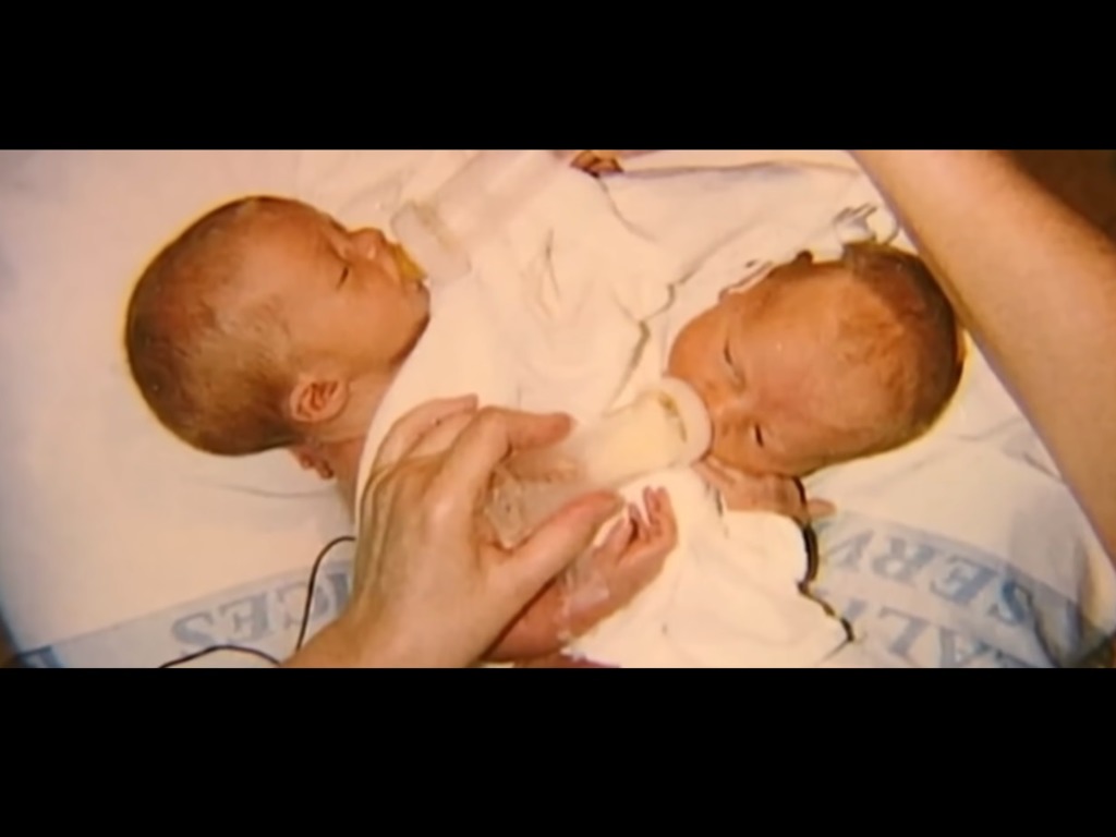 在20年前,美國一對連體嬰姊妹經歷了31小時的手術,順利分割並過著屬於自己的人生。