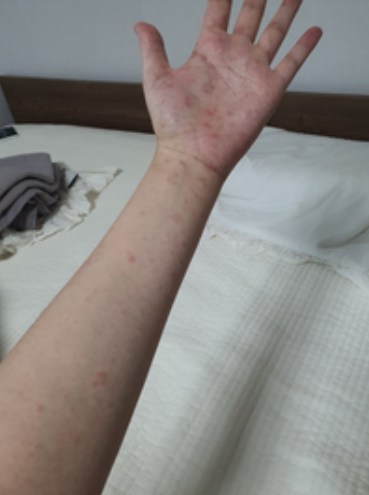 「nicole3768」表示雖然醫生處方了類固醇和抗過敏藥物給她,但到了第7天症狀依舊沒有改善,出疹情況還變得更嚴重。