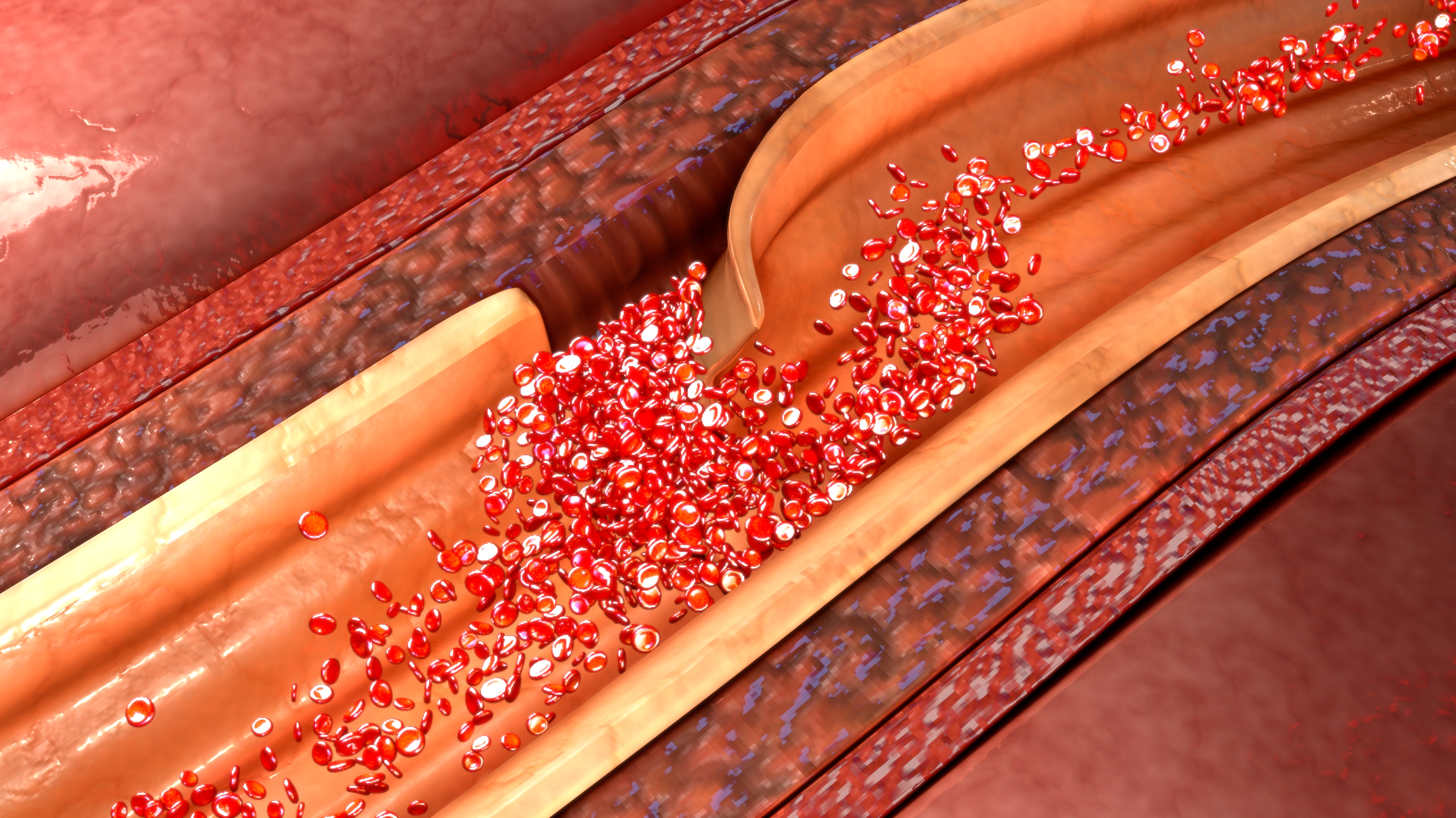主動脈剝離有可能導致腦中風,死亡率非常高。