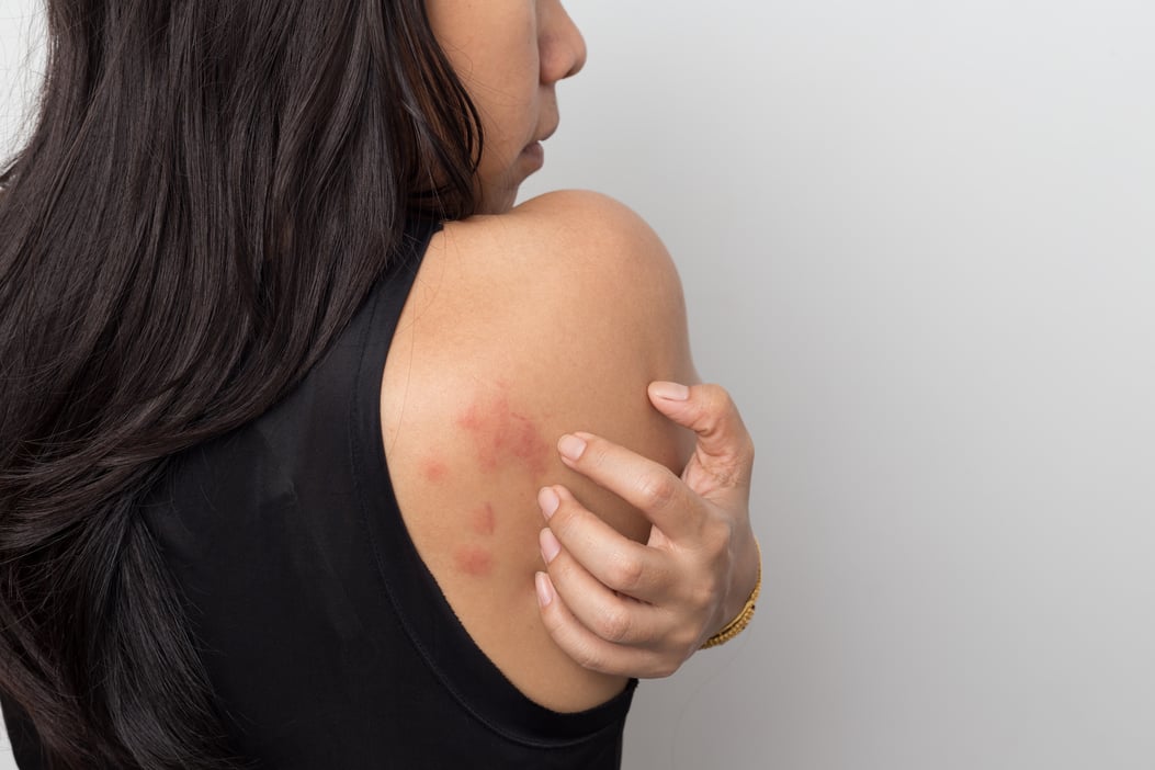 【皮膚癬VS濕疹】同樣皮膚痕癢、脫皮?了解7大分別(附照片)