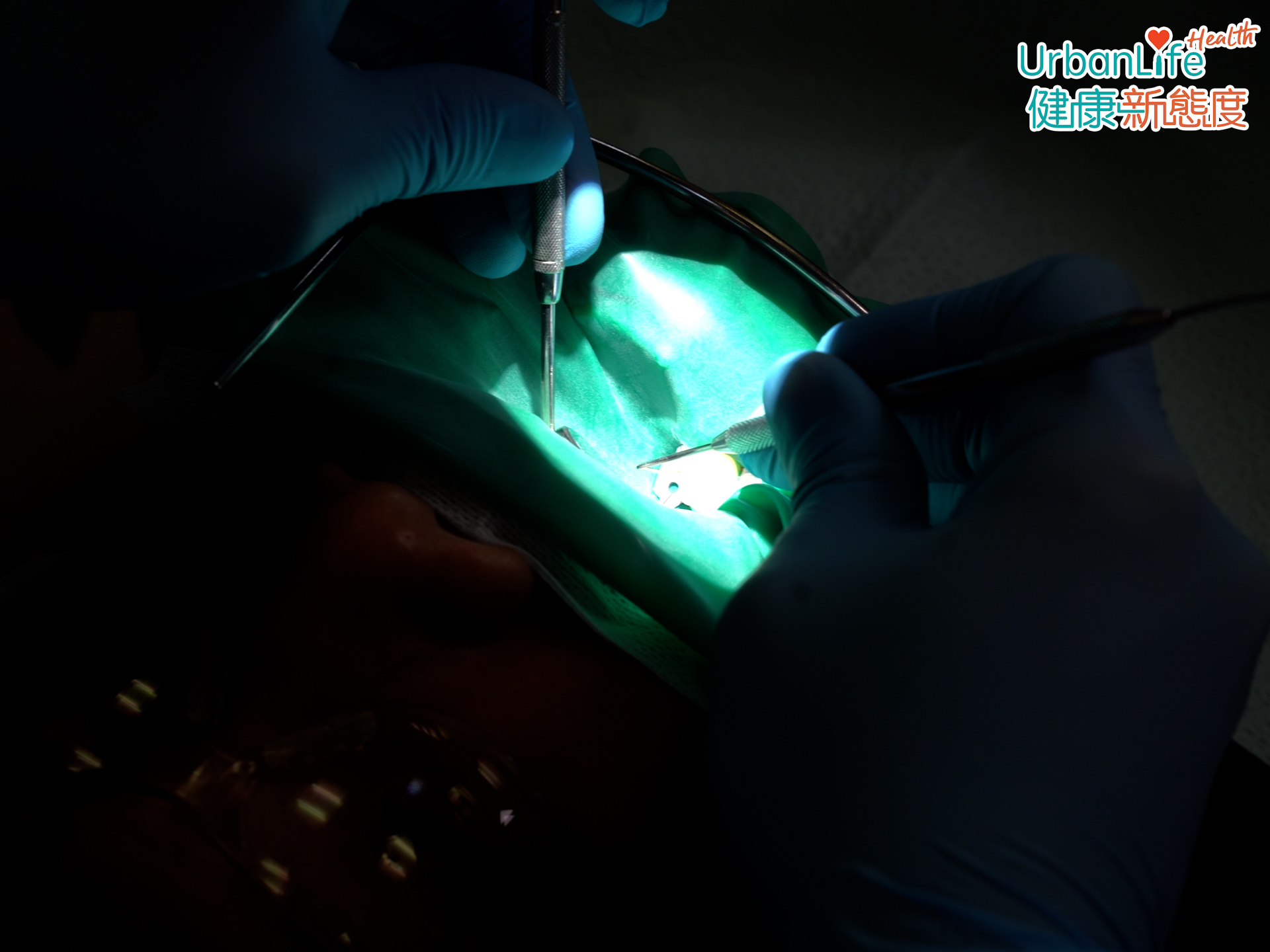 ,醫生進行杜牙根,必然會先為患者作麻醉,過程中大部分患者都不會感到疼痛。