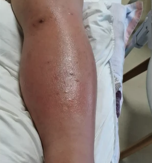 杭州一名38周孕婦,左小腿被蚊叮,惟3天後患處腫脹潰爛,她更發起高燒。