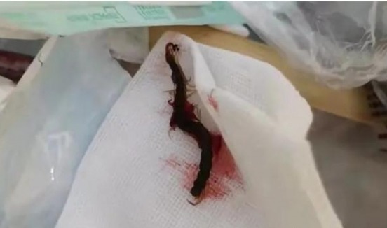 李女士耳內夾出一條長達5厘米的蜈蚣。